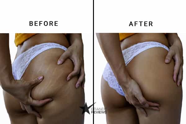 Palmer's Stretch Mark Cream Before and After