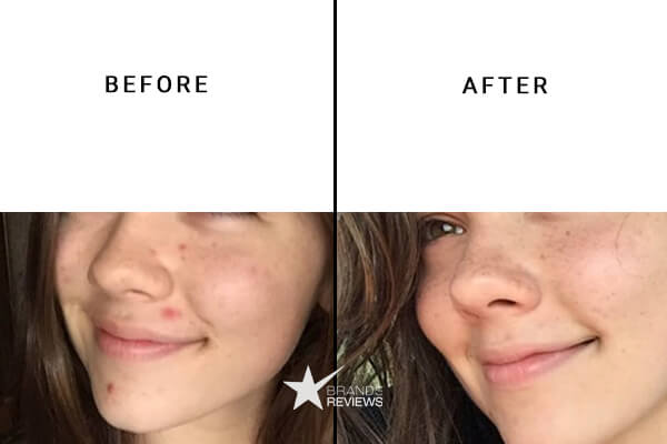 Paula's Choice Salicylic Acid Serum Before and After