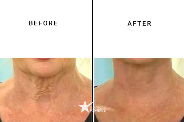 Perricone MD Neck Firming Cream Before and After
