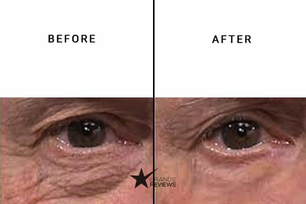 Plexaderm Anti-Aging Serum Before and After
