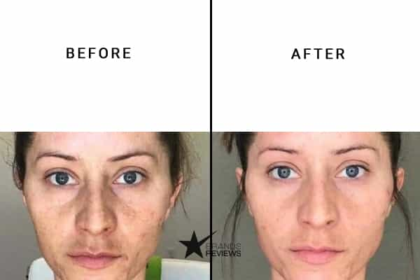 Plexaderm Collagen Serum Before and After