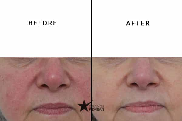 Plexaderm Hyaluronic Acid Serum Before and After