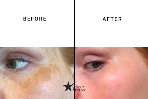 Plexaderm Vitamin C Serum Before and After