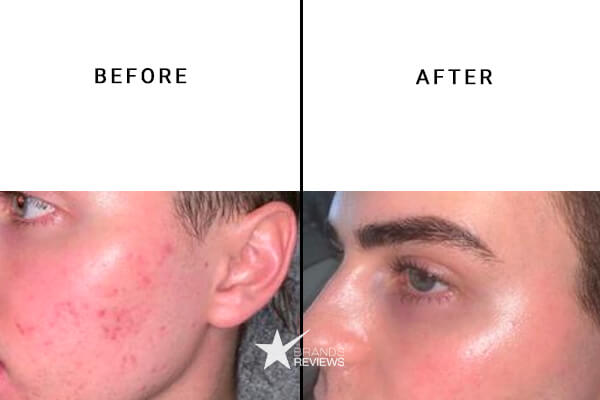 PotentLift Retinol Cream Before and After