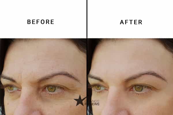 Preparation H Anti-Aging Serum Before and After