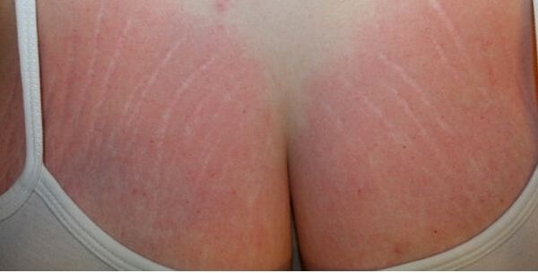 Remove Stretch Marks From Breast