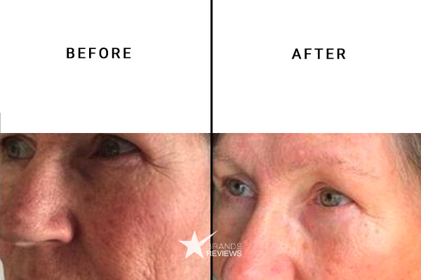 Revision Eye Cream Before and After