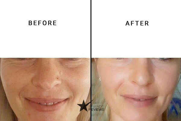 Revision Peptide Serum Bevires and After