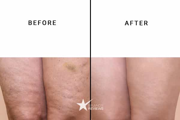 Revision Skincare Cellulite Cream Before and After