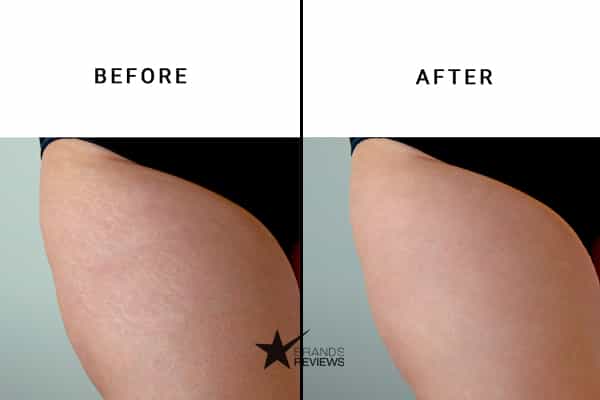 Revitol Stretch Mark Cream Before and After