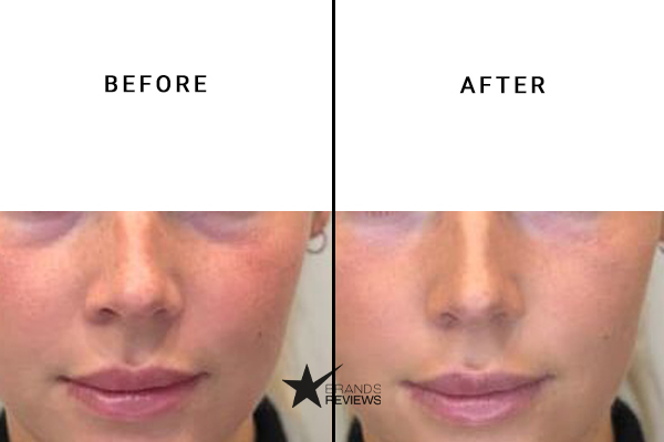 Robin McGraw Revelation Stem Cell Mask Before and After