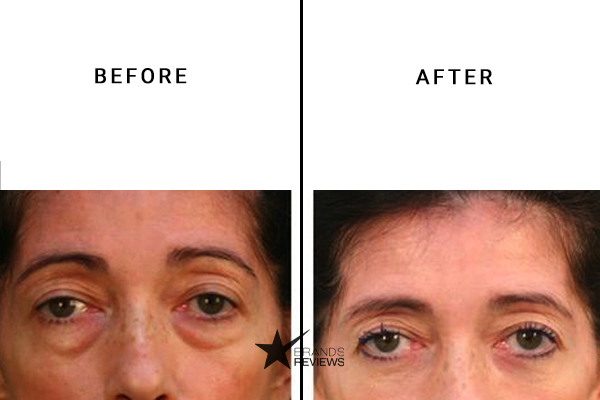 RoC Skincare Eye Cream Before and After