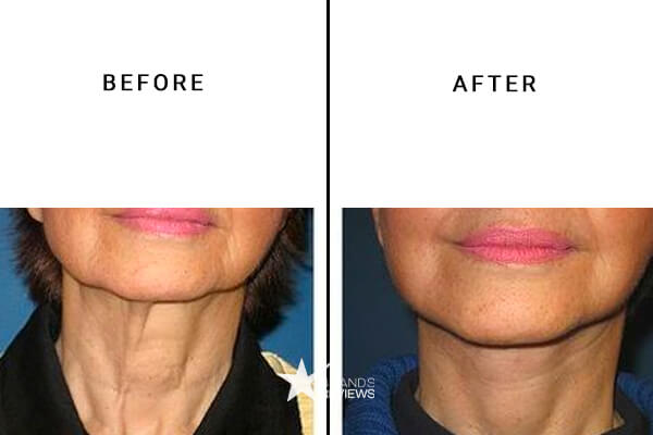 RoC Skincare Neck Firming Cream Before and After