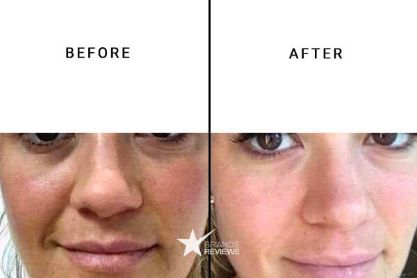 RoC Skincare Retinol Cream Before andAfter