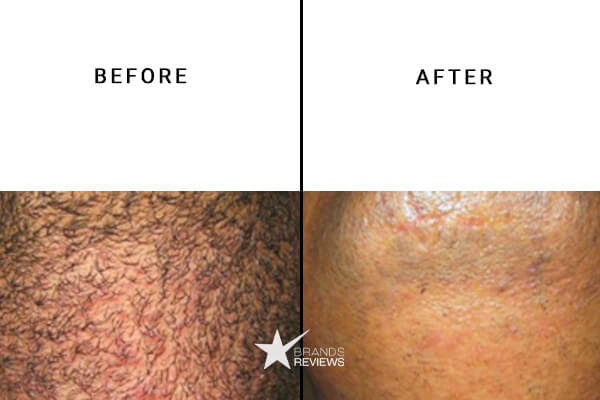 Silk'n laser hair removal device before and after