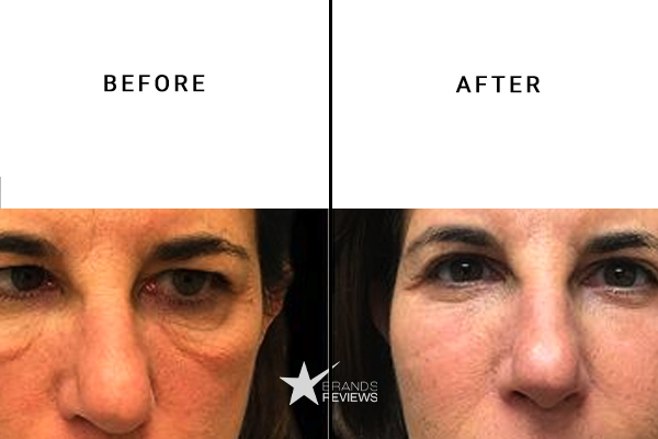 SkinCeuticals Eye Cream Before and After