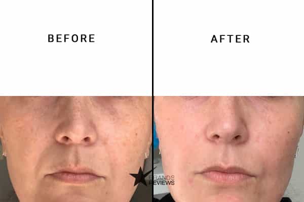 Skinceuticals Hyaluronic Acid Serum Before and After