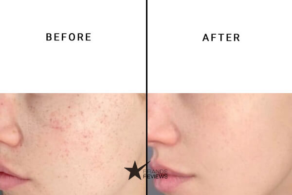 Skinceuticals Hyaluronic Acid Serum Before and After