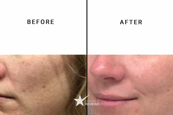 SkinMedica Hyaluronic Acid Serum Before and After