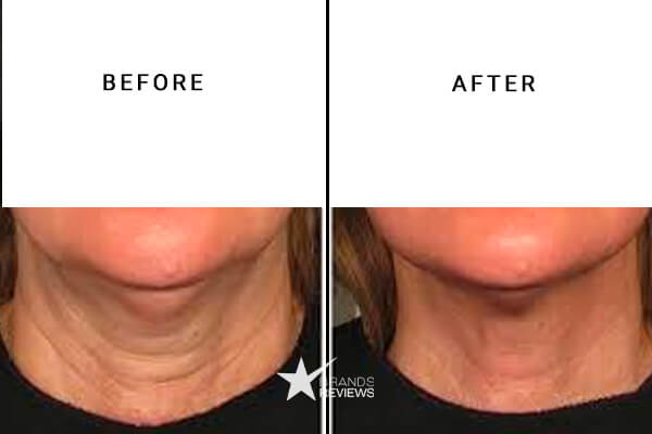 SkinMedica Neck Firming Cream Before and After