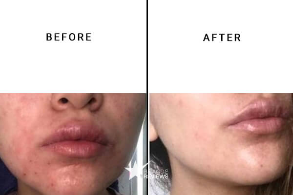 SkinMedica Retinol Cream Before and After