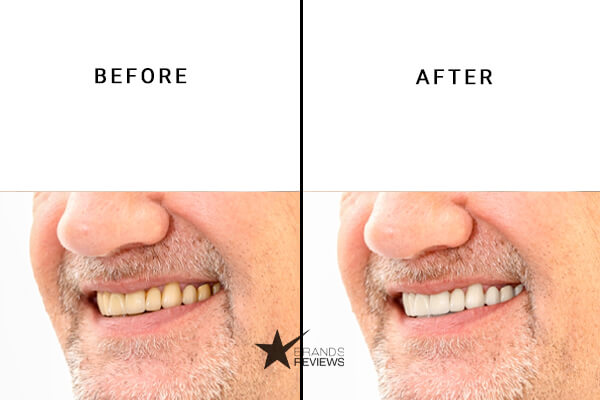 Smile Brilliant Water Flosser Before and After