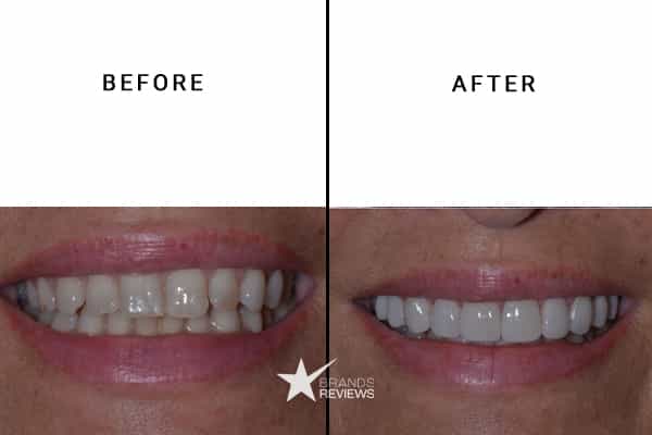Snow Teeth Whitening Kit Before and After