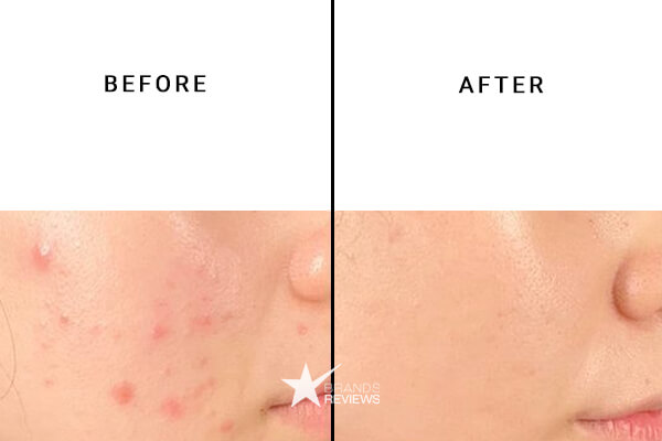 Social CBD Acne Cream Before and After
