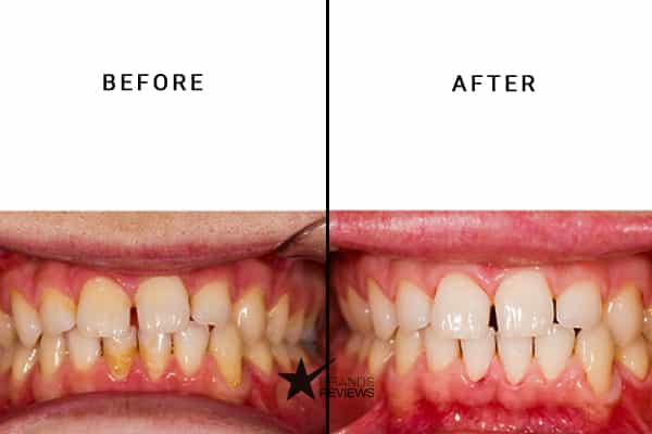Spotlight Oral Care Water Flosser Before and After
