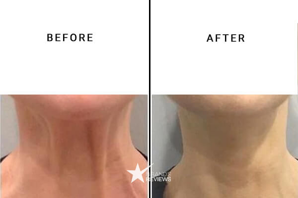 Strivectin Neck Firming Cream Before and After