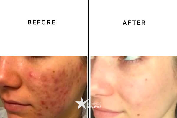 Sunday Riley Retinol Serum Before and After