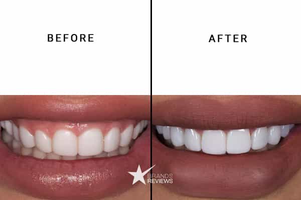 SuperSmile Teeth Whitening Kit Before and After