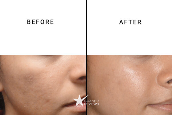 Tata Harper Salicylic Acid Serum Before and After