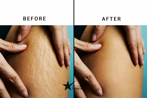 Tetyana Stretch Mark Cream Before and After