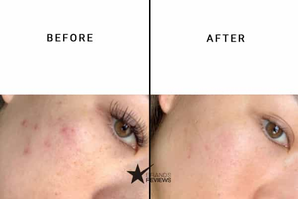 The Inkey List Hyaluronic Acid Serum Before and After