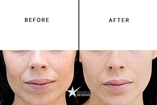 The Inkey List Salicylic Acid Serum Before and After