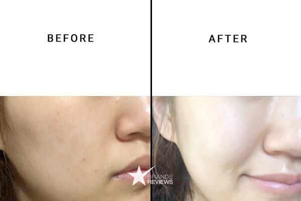 The Ordinary Acne And Blemish Serum Before and After