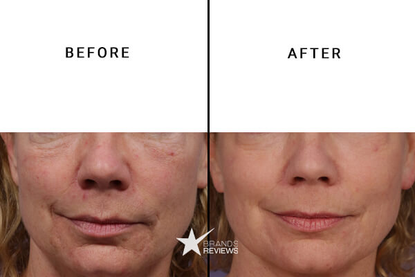 The Ordinary Antioxidant Serum Before and After
