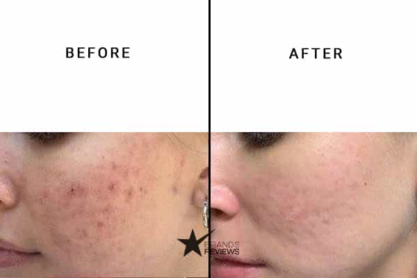The Ordinary Hyaluronic Acid Serum Before and After
