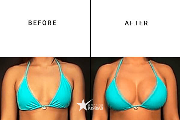 Total Curve Breast Enlargement Before and After
