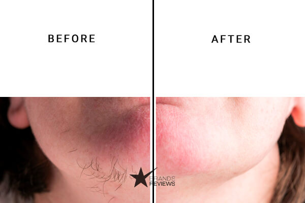 Tria Laser Hair Removal Device before and after