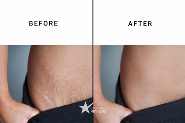 Trilastin Stretch Mark Cream Before and After