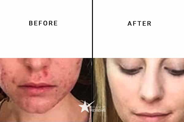 Trufora Night Serum Before and After