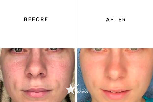 Typology Retinol Serum Before and After