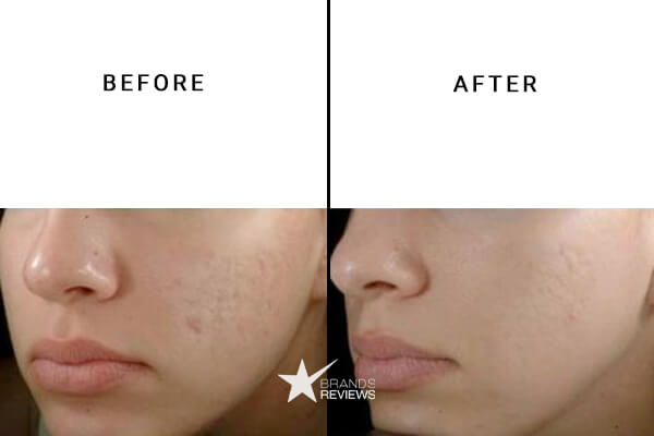 Urban Skin Rx Acne And Blemish Serum Before and After
