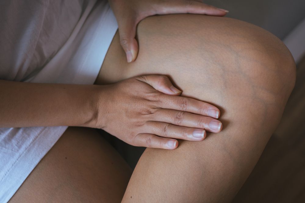 Varicose Veins And Stretch Marks