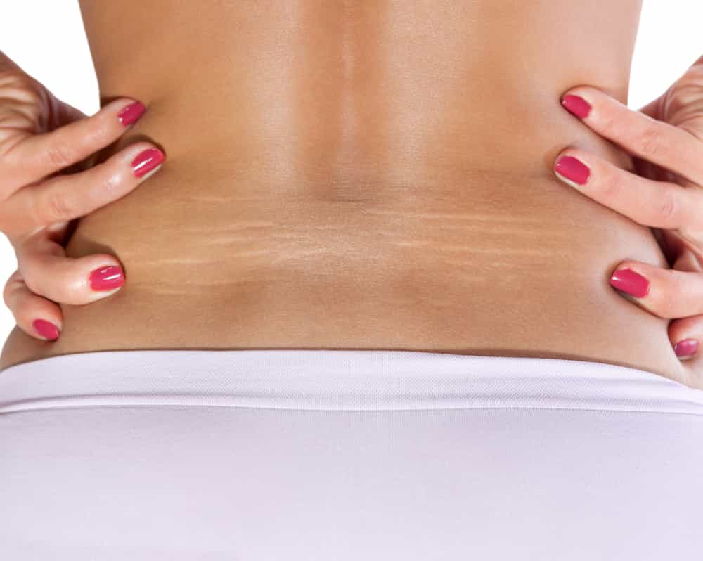 When should you use stretch mark cream?