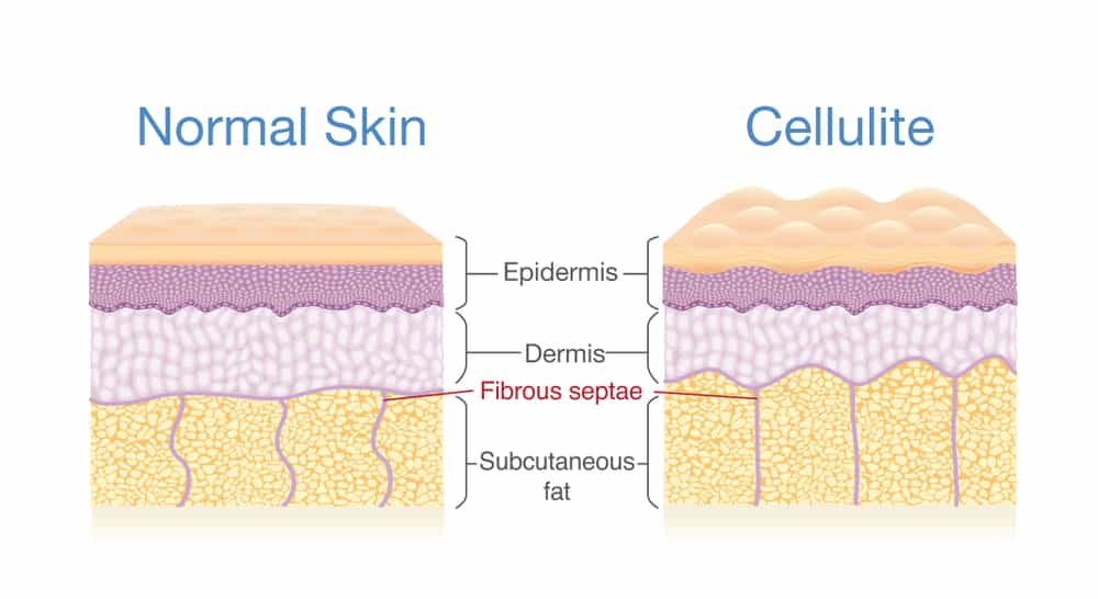 where cellulite come from?