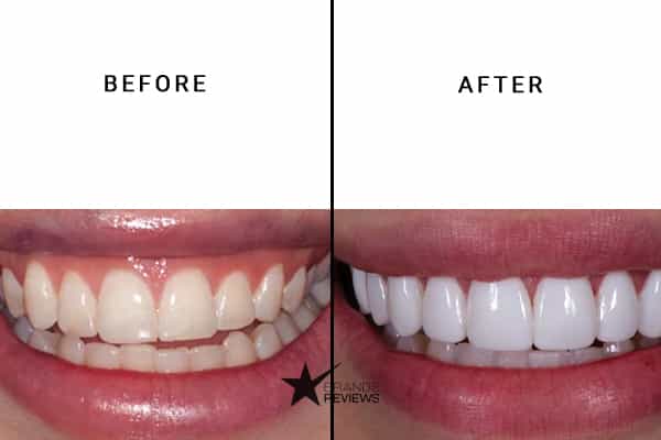 Whitify Teeth Whitening Kit Before and After