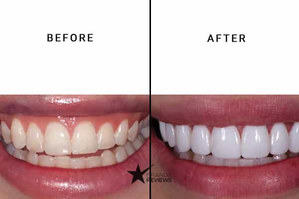 Whitify Teeth Whitening Kit Before and After